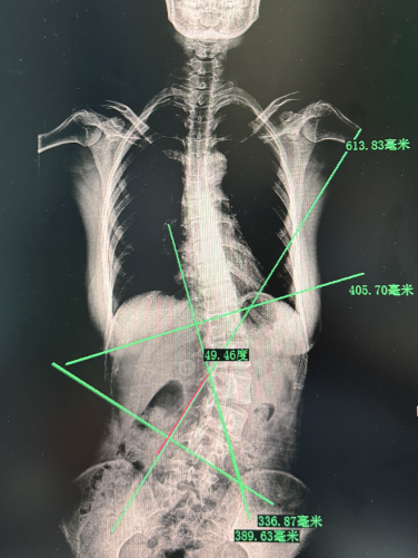 什么！脊柱矯正還能長(zhǎng)高？